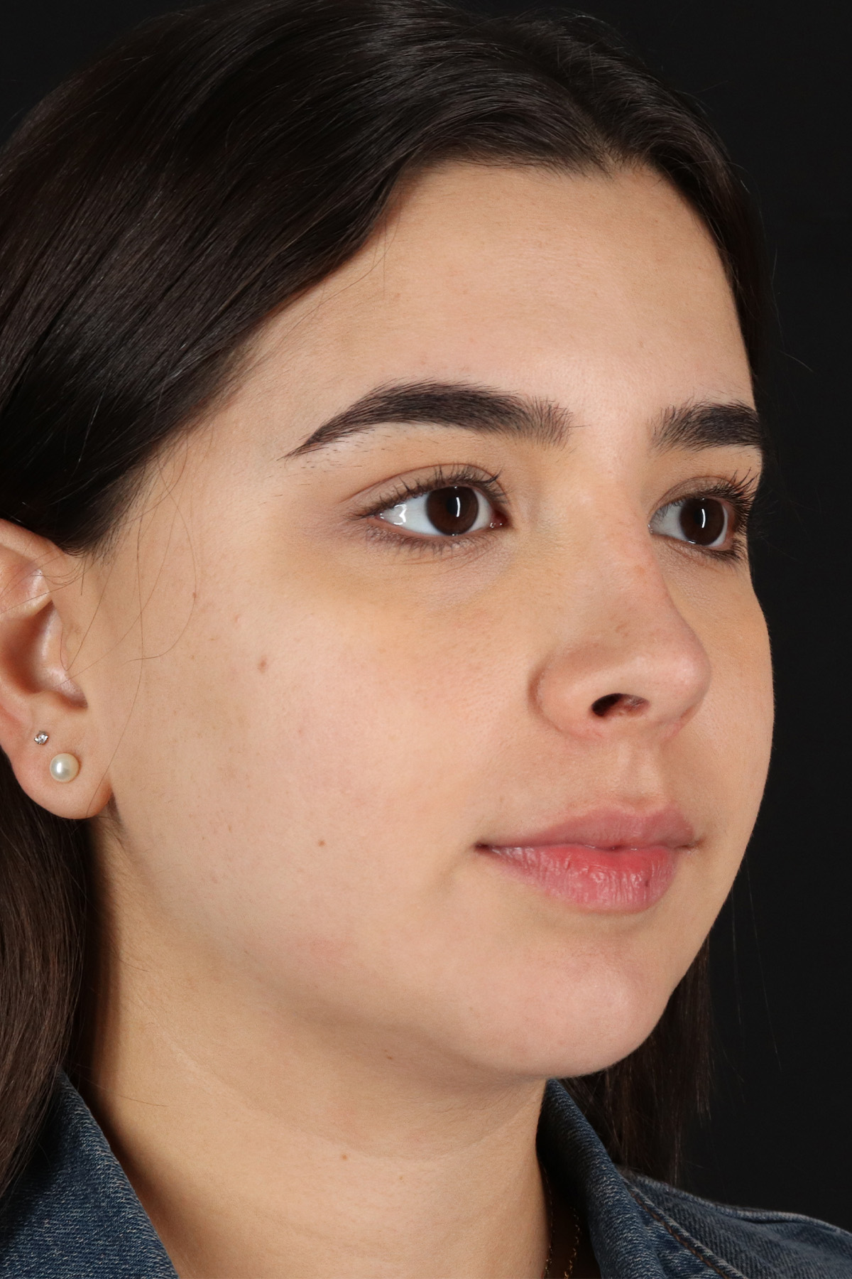 Chin Implant Before & After Patient #11694