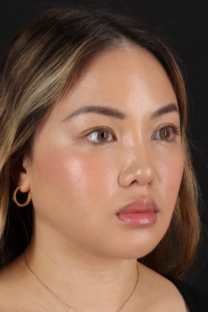 Chin Implant Before & After Patient #13816