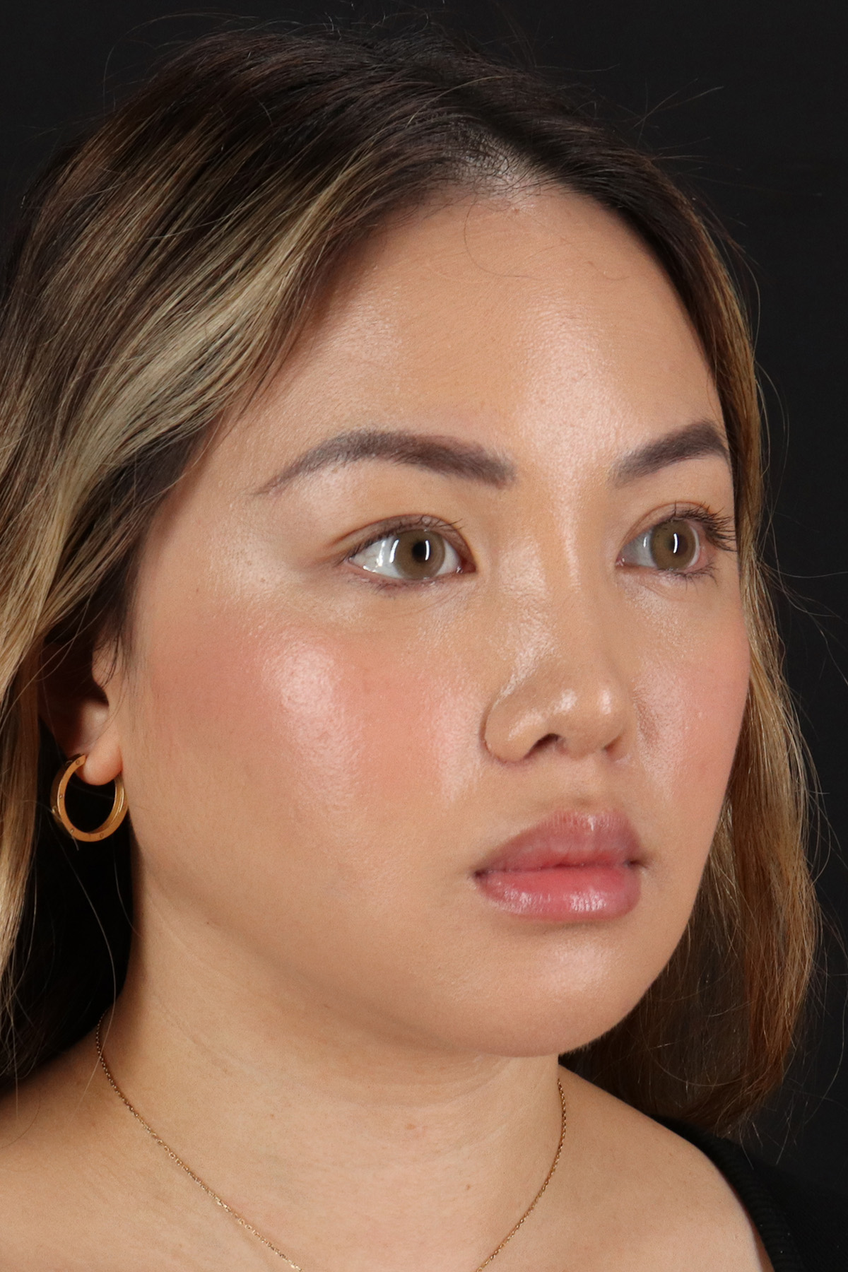 Chin Implant Before & After Patient #13816
