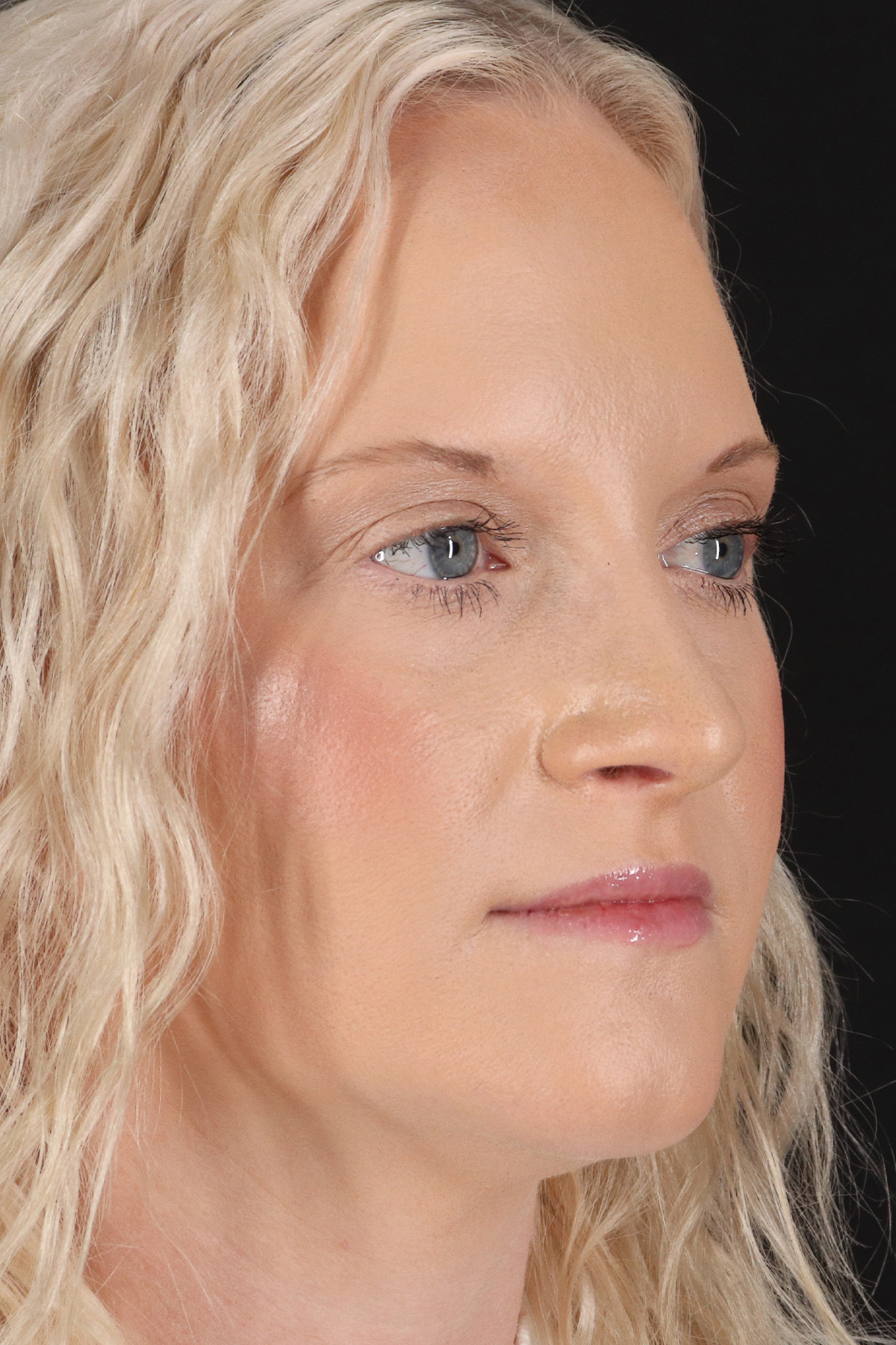 Rhinoplasty Before & After Patient #12381