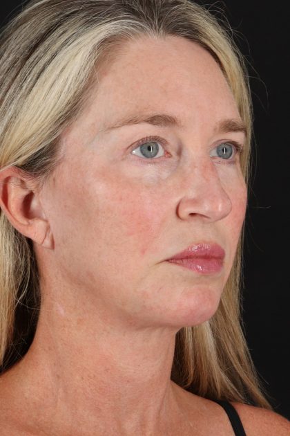 Upper Blepharoplasty Before & After Patient #12084