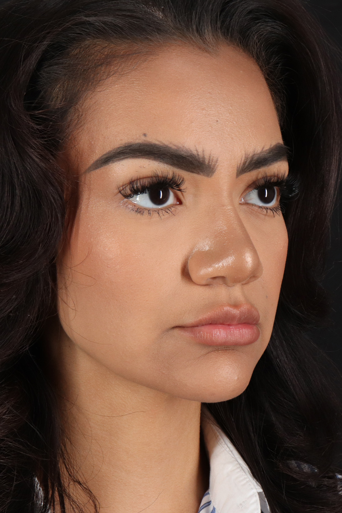 Rhinoplasty Before & After Patient #12326