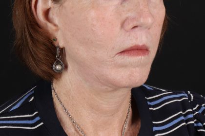 Neck Liposuction Before & After Patient #12117