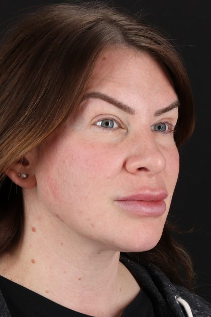 Rhinoplasty Before & After Patient #12414