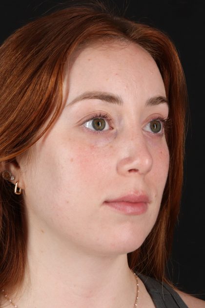 Rhinoplasty Before & After Patient #12348