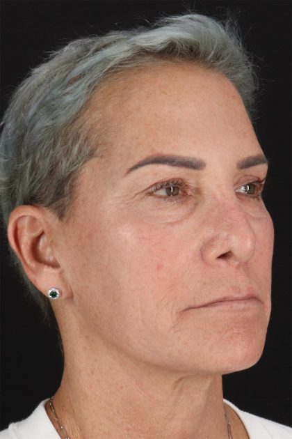 CO2 Laser Before & After Patient #10980