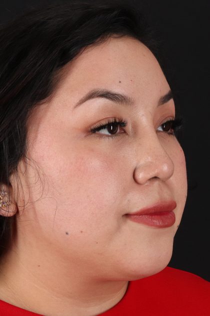 Rhinoplasty Before & After Patient #12447