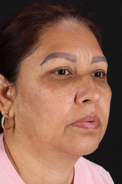 Upper Blepharoplasty Before & After Patient #12051