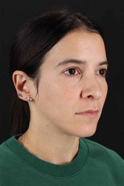 CO2 Laser Before & After Patient #11103
