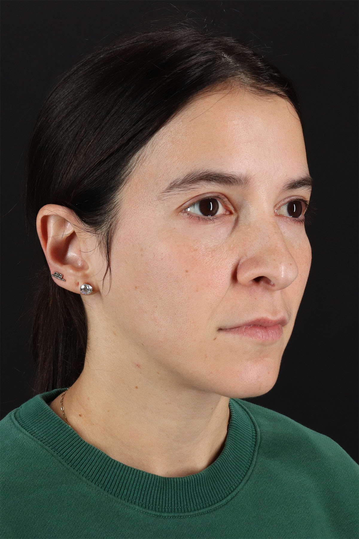 CO2 Laser Before & After Patient #11103