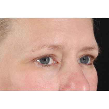 Blepharoplasty (Eyelid Surgery) Before & After Patient #10991