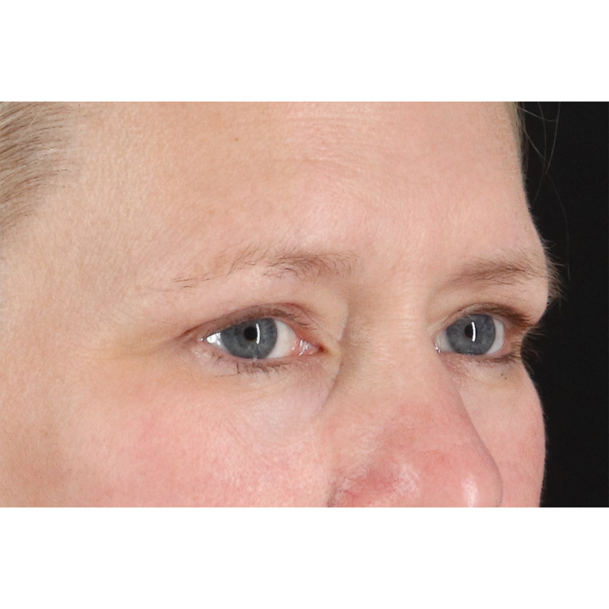 Blepharoplasty (Eyelid Surgery) Before & After Patient #10991