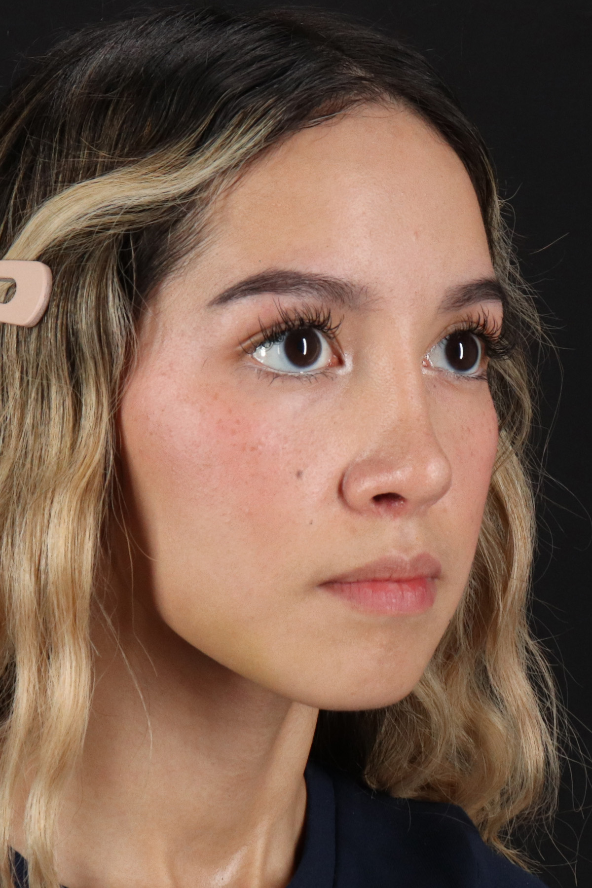 Rhinoplasty Before & After Patient #12216