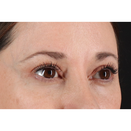 Blepharoplasty (Eyelid Surgery) Before & After Patient #11114