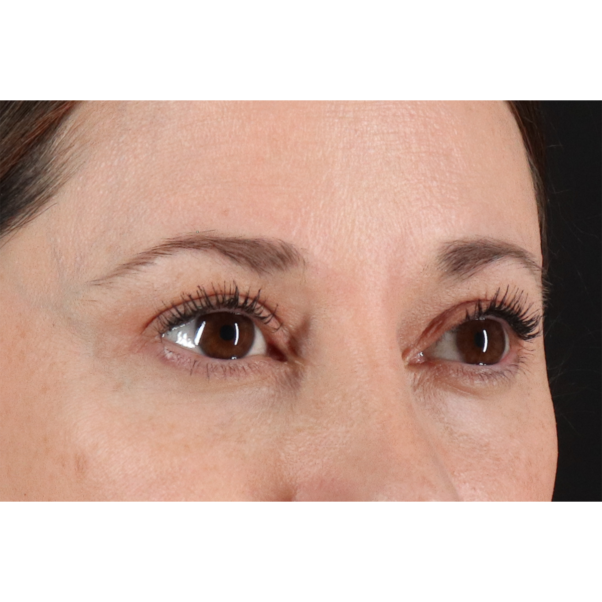 Blepharoplasty (Eyelid Surgery) Before & After Patient #11114