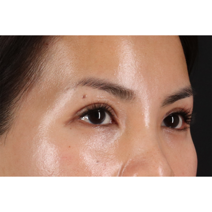 Blepharoplasty (Eyelid Surgery) Before & After Patient #10782