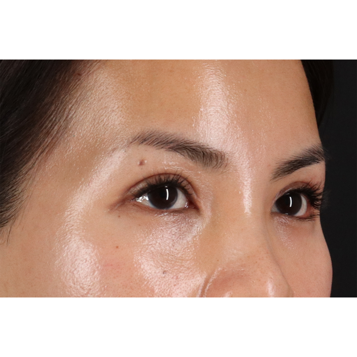 Blepharoplasty (Eyelid Surgery) Before & After Patient #10782
