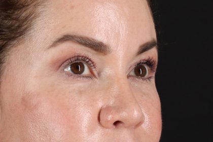 Rhinoplasty Before & After Patient #12656
