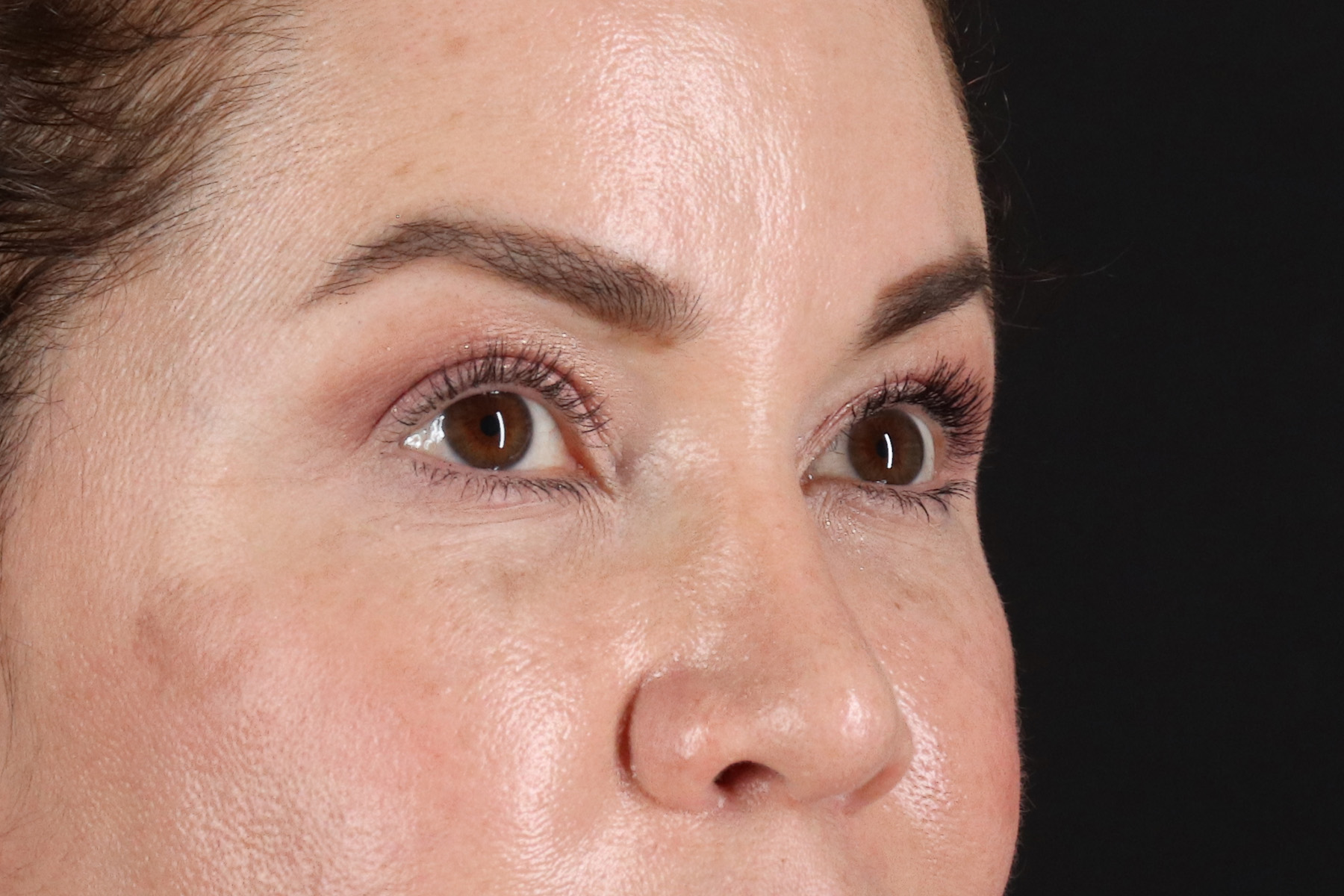 Upper Blepharoplasty Before & After Patient #12073