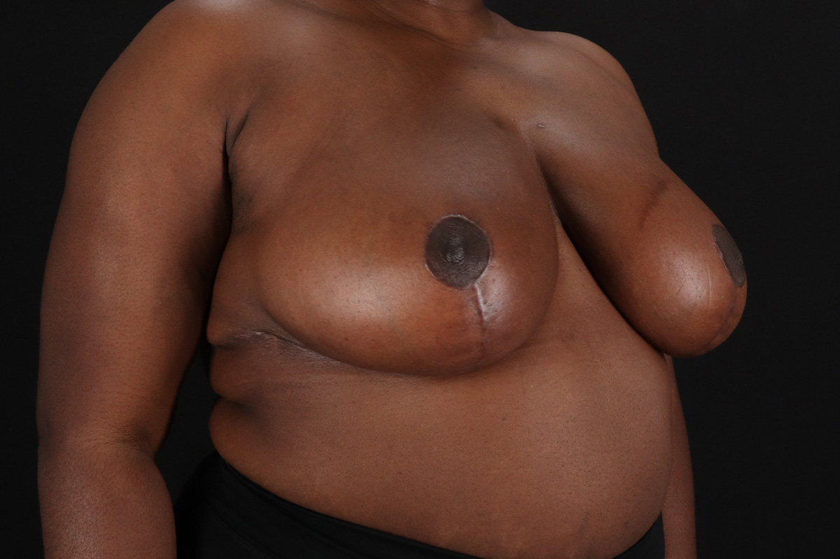 Breast Reduction With Lift Before & After Patient #11484