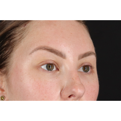 Brow Lift Before & After Patient #11657