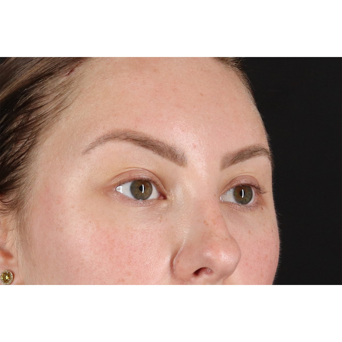Brow Lift Before & After Patient #11657