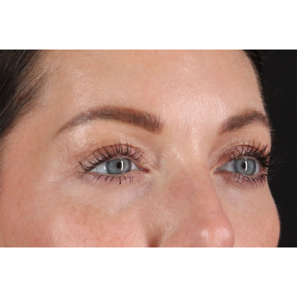 Blepharoplasty (Eyelid Surgery) Before & After Patient #11026