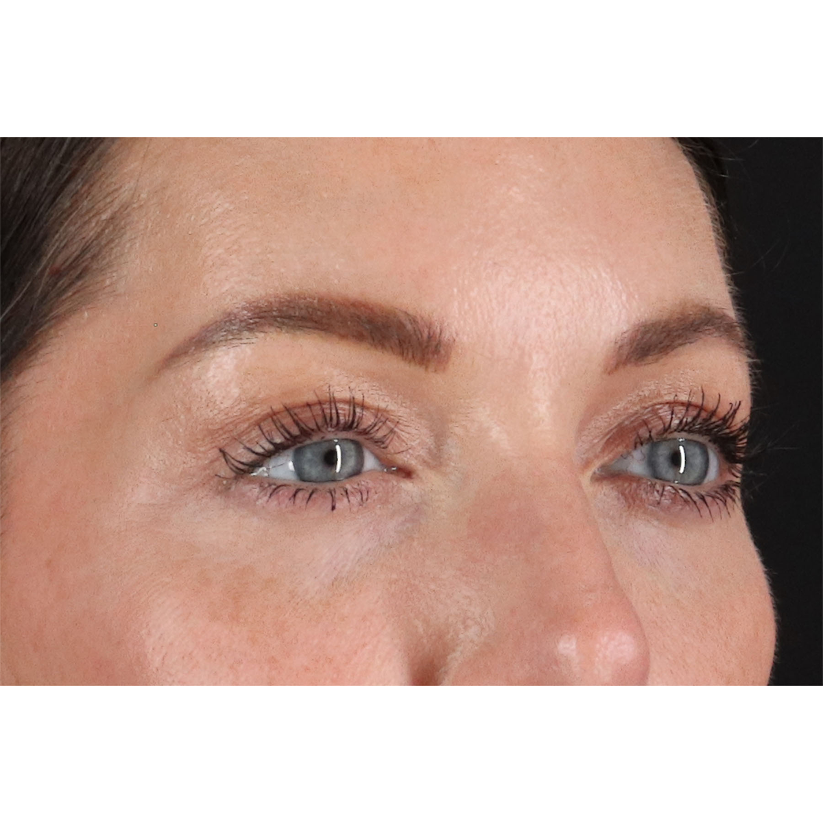 Blepharoplasty (Eyelid Surgery) Before & After Patient #11026