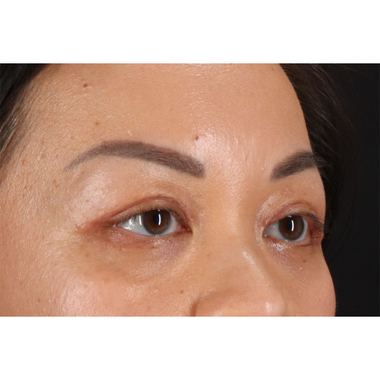 Blepharoplasty (Eyelid Surgery) Before & After Patient #11037