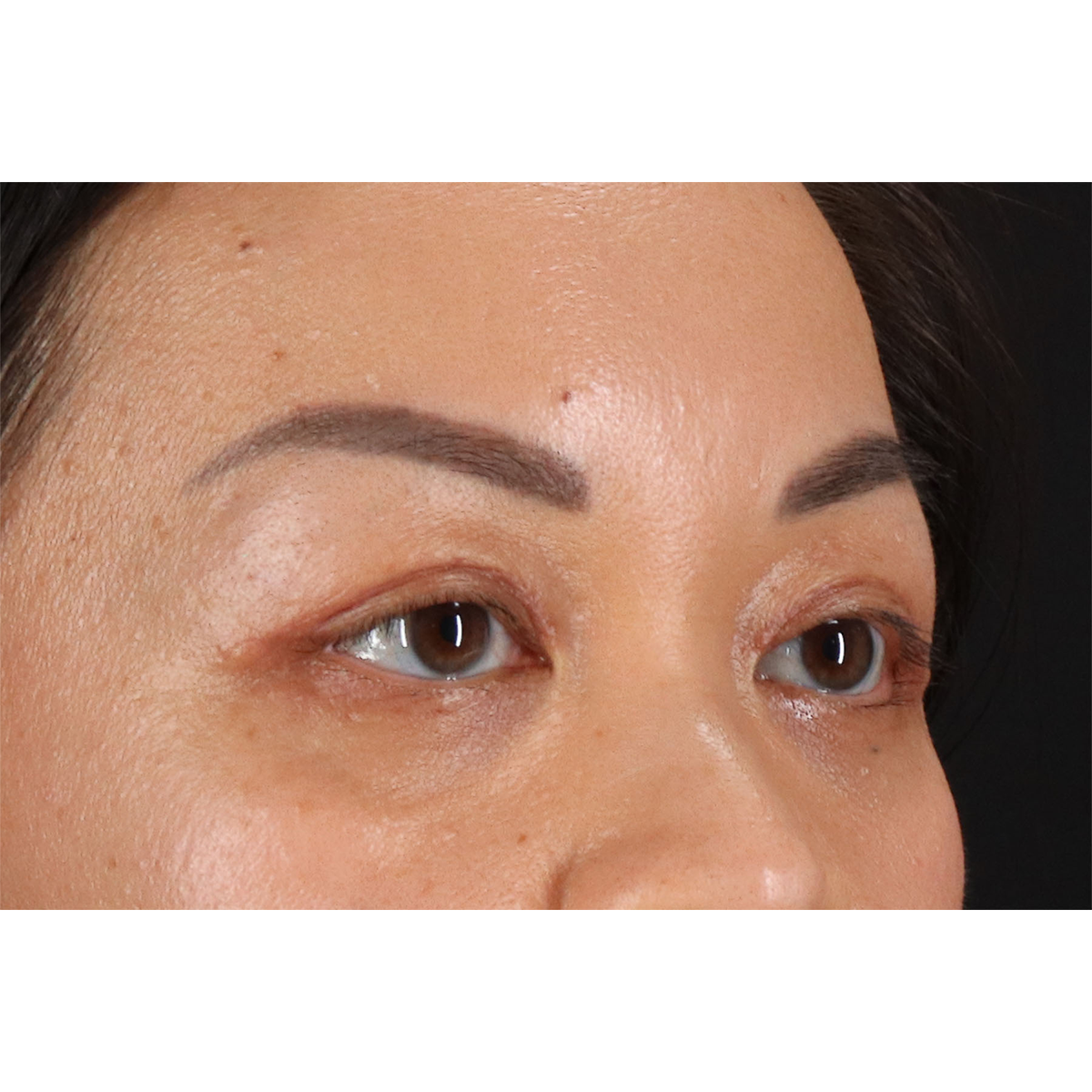 Blepharoplasty (Eyelid Surgery) Before & After Patient #11037