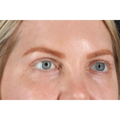 Blepharoplasty (Eyelid Surgery) Before & After Patient #11158