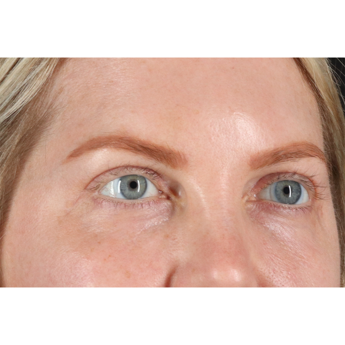 Blepharoplasty (Eyelid Surgery) Before & After Patient #11158