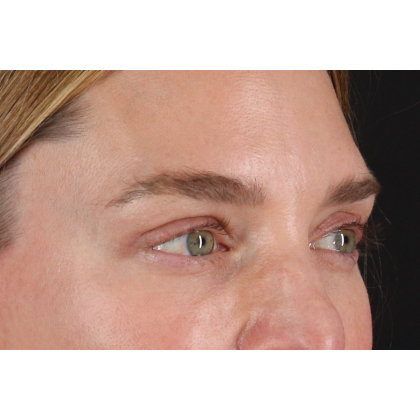 Blepharoplasty (Eyelid Surgery) Before & After Patient #11541