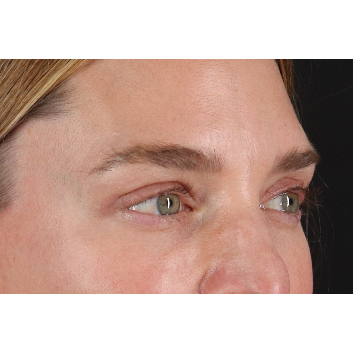Blepharoplasty (Eyelid Surgery) Before & After Patient #11541