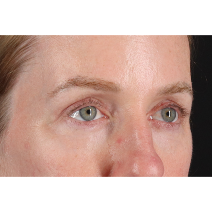 Blepharoplasty (Eyelid Surgery) Before & After Patient #11883