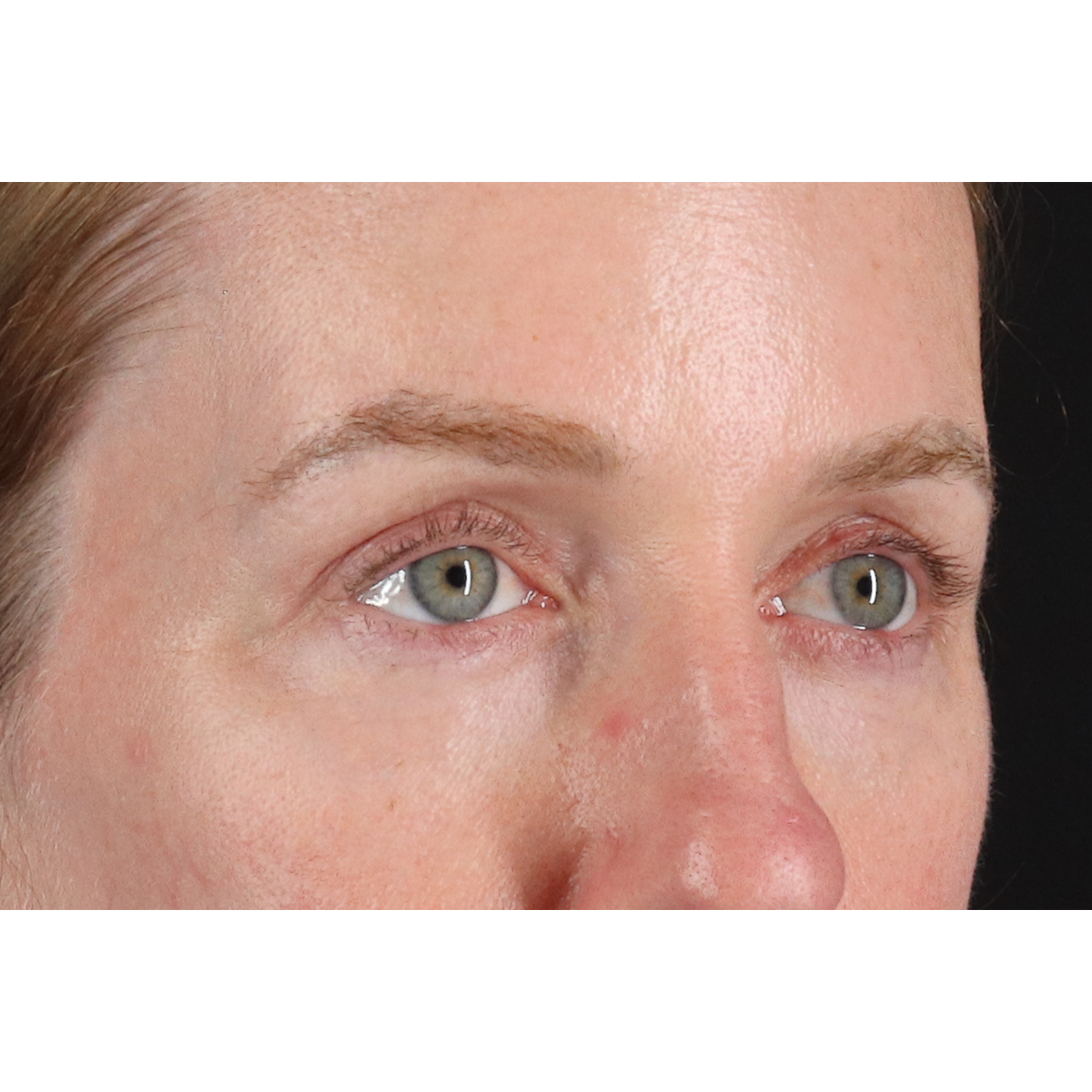 Blepharoplasty (Eyelid Surgery) Before & After Patient #11883