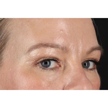 Blepharoplasty (Eyelid Surgery) Before & After Patient #11048