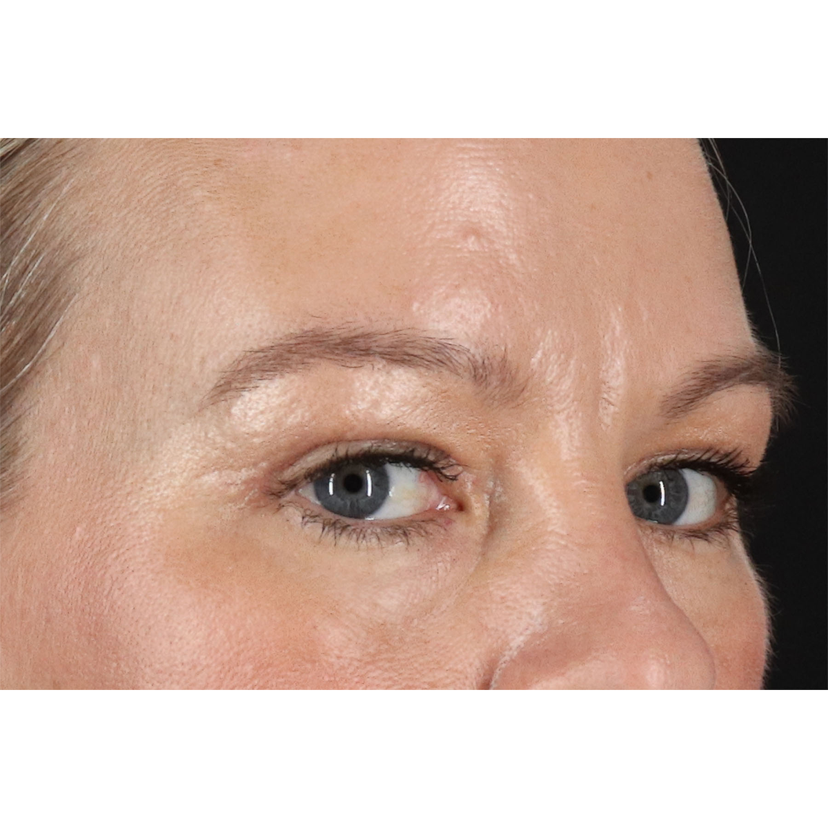 Blepharoplasty (Eyelid Surgery) Before & After Patient #11048