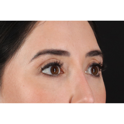 Blepharoplasty (Eyelid Surgery) Before & After Patient #11668