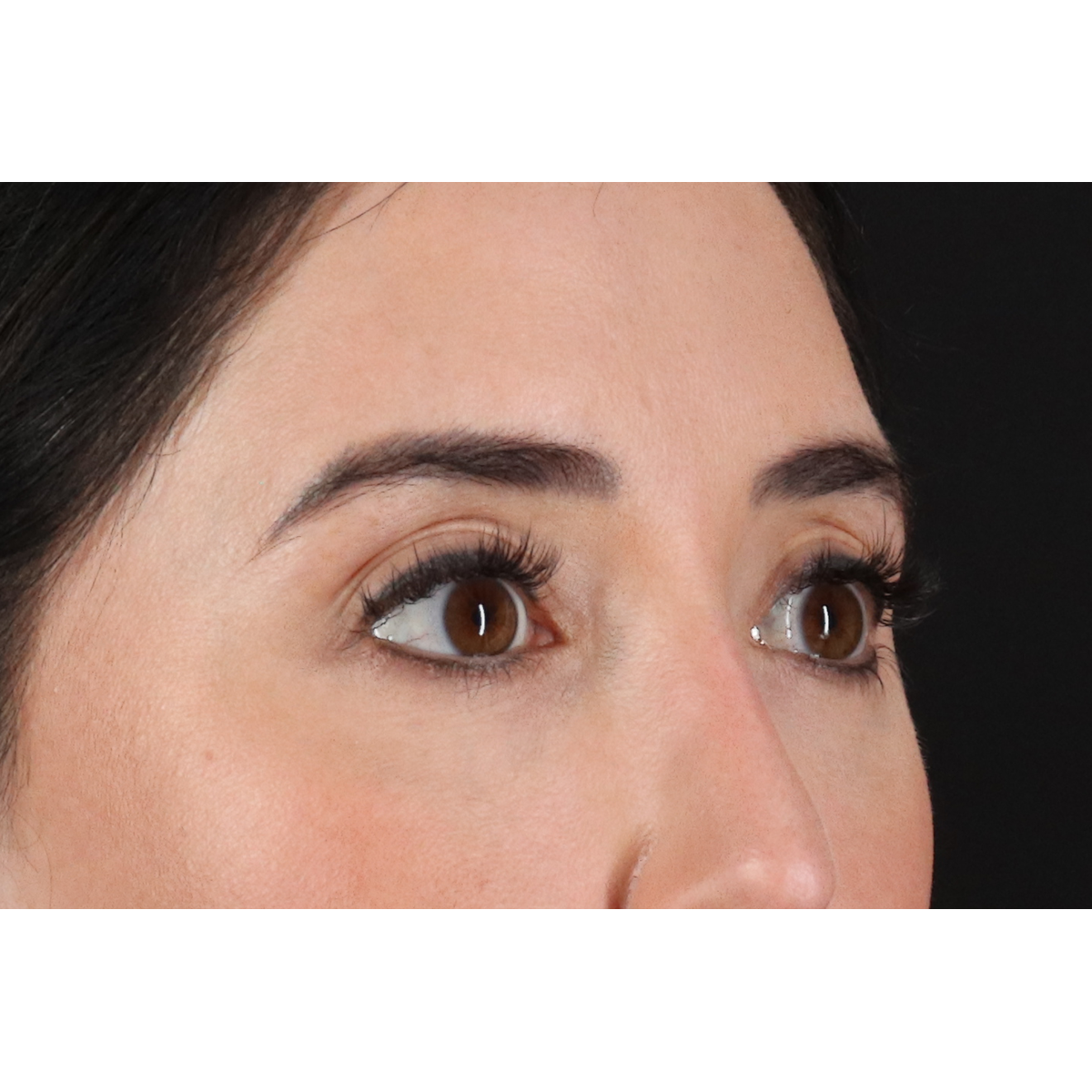 Blepharoplasty (Eyelid Surgery) Before & After Patient #11668