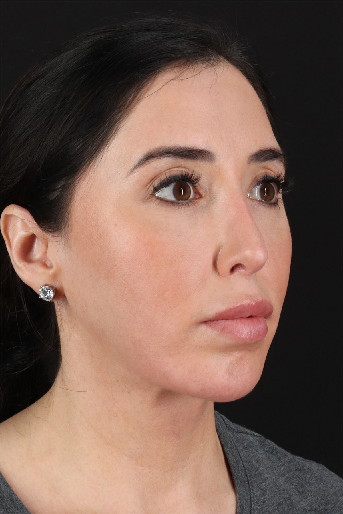 Fat Grafting To The Face Before & After Patient #11783