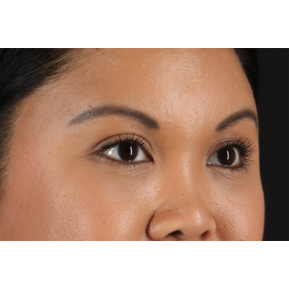 Brow Lift Before & After Patient #11646