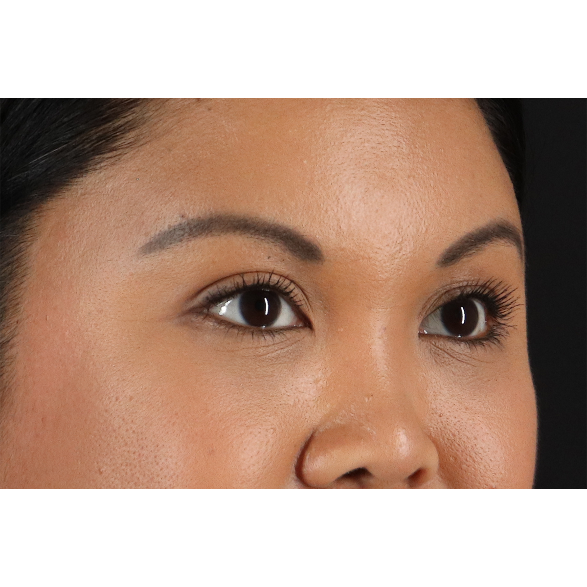 Brow Lift Before & After Patient #11646