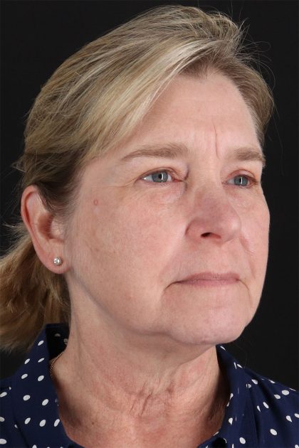 CO2 Laser Before & After Patient #11191
