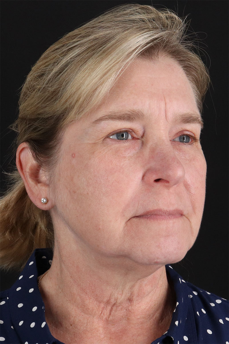 CO2 Laser Before & After Patient #11191
