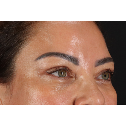Blepharoplasty (Eyelid Surgery) Before & After Patient #11348