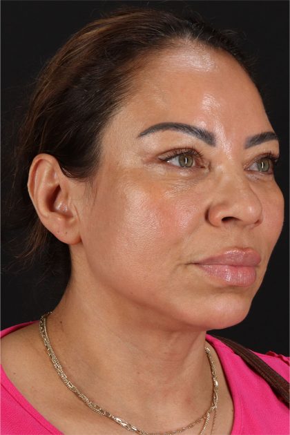 CO2 Laser Before & After Patient #11719