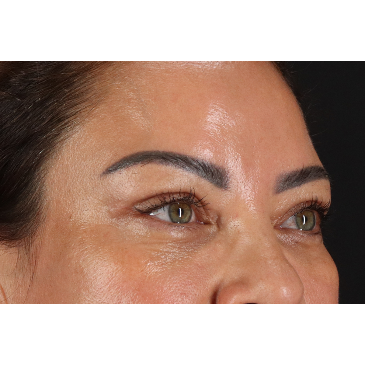 Blepharoplasty (Eyelid Surgery) Before & After Patient #11348