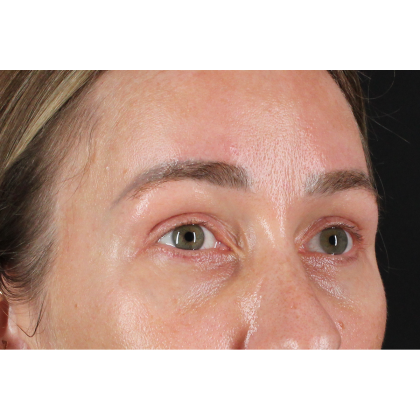 Blepharoplasty (Eyelid Surgery) Before & After Patient #11585