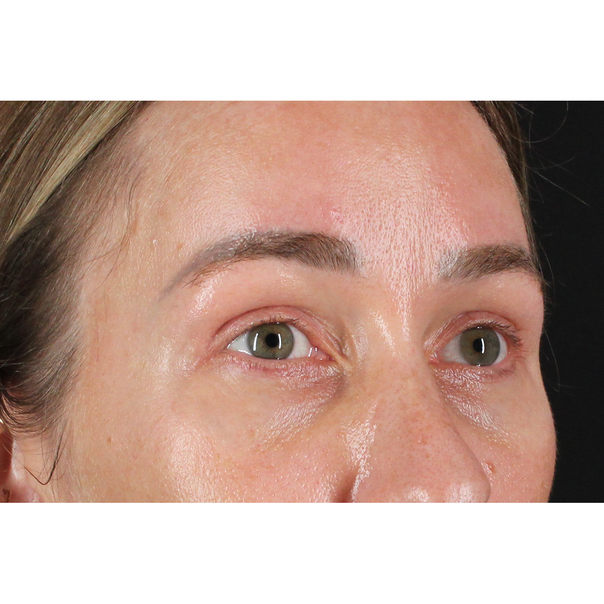 Blepharoplasty (Eyelid Surgery) Before & After Patient #11585